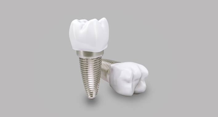 ARE DENTAL IMPLANTS SAFE IN THE FUTURE?