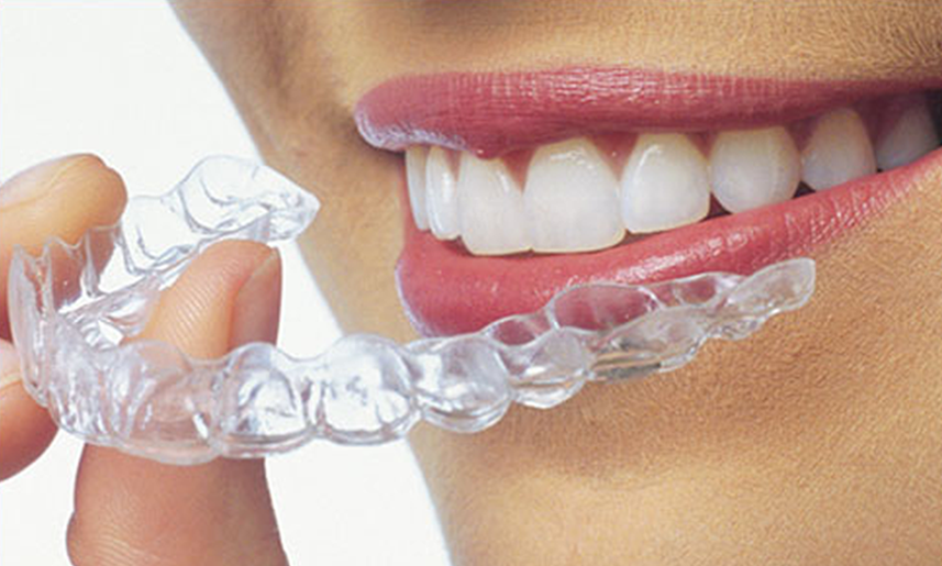 7 Myths and Facts About Clear Aligners 